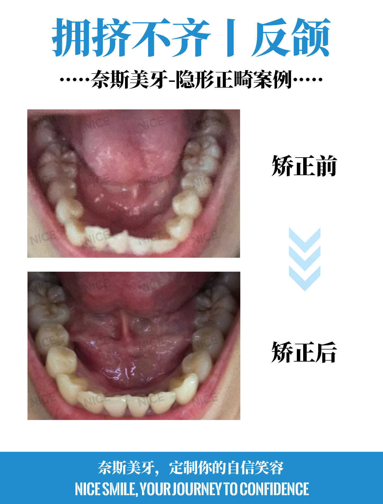 下牙对比