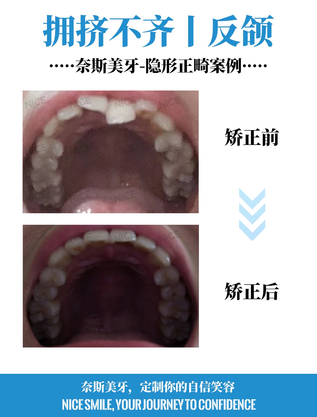上牙对比