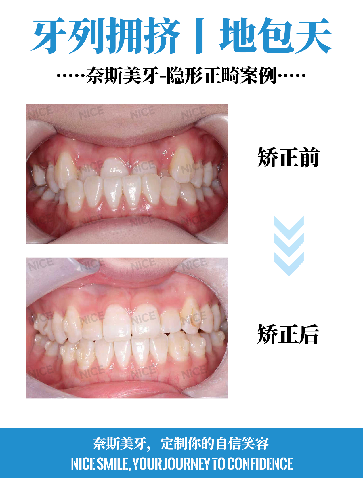 正面咬合对比