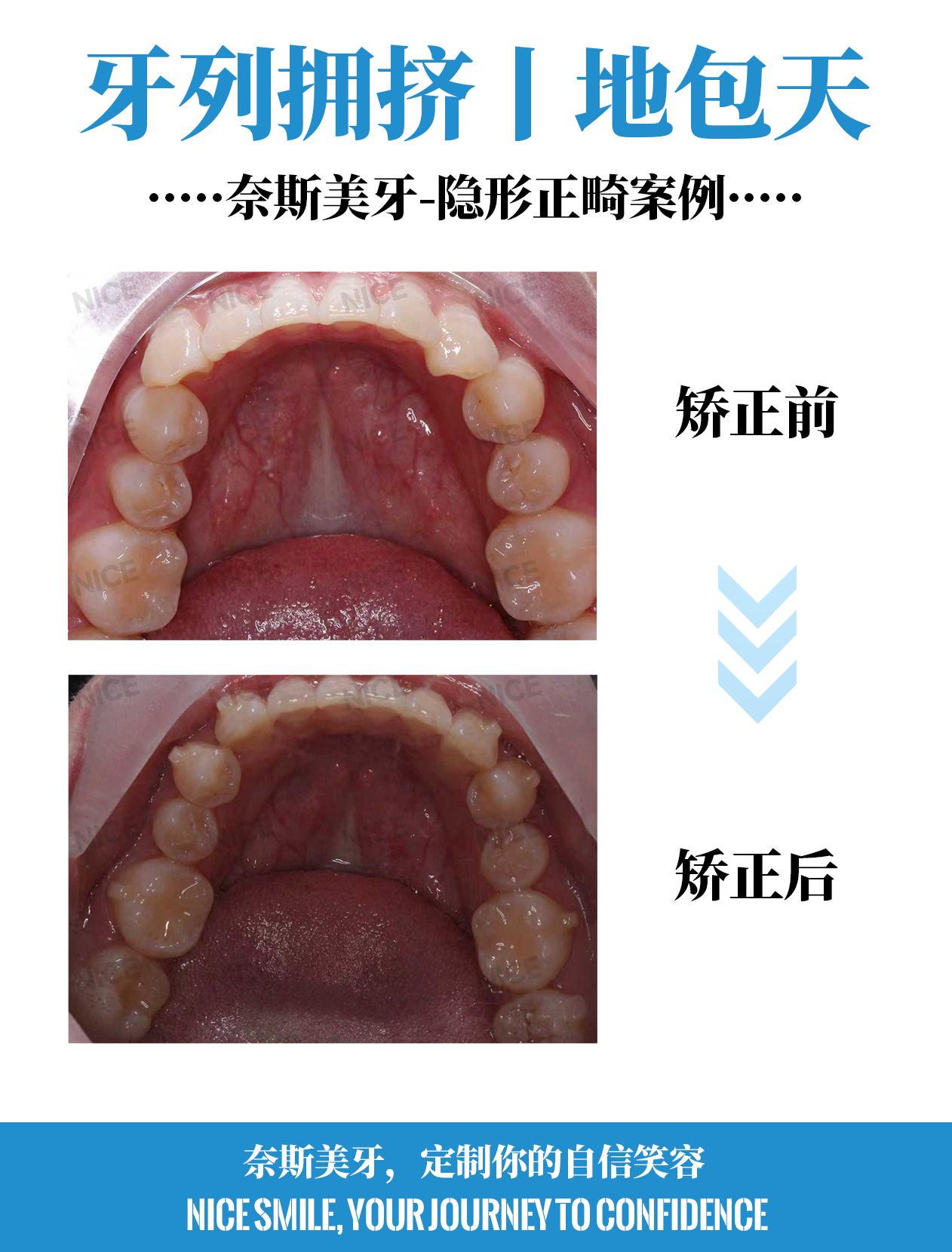 下牙对比
