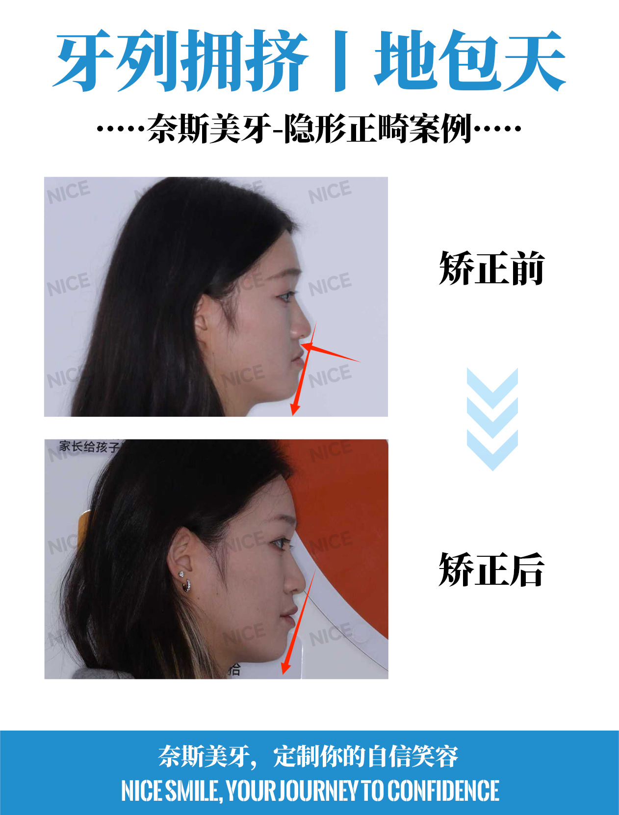 地包天、拥挤隐形正畸案例