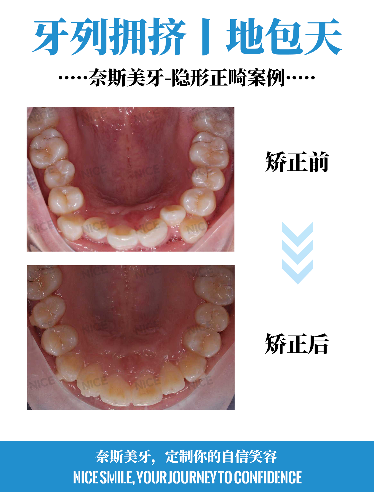 上牙对比